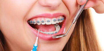 لزوم جرمگیری حین درمان ارتودنسی